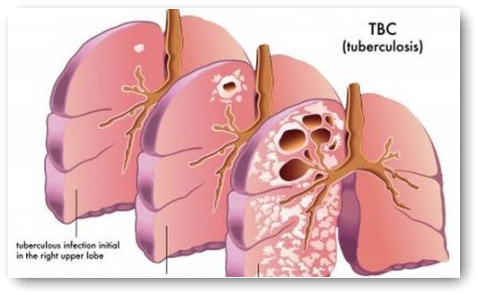 Lima Orang Meninggal Dunia karena TBC