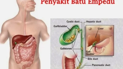 Penyebab Batu Empedu