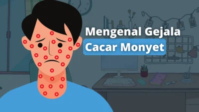 Kata Kemenkes Mengenai kasus Cacar Monyet : Penularan, Gejala dan Tanda-Tanda