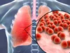 Mengenal dan Mencegah Penyakit Pneumonia