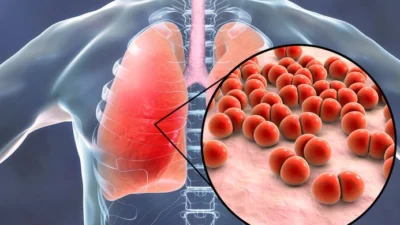 Mengenal dan Mencegah Penyakit Pneumonia