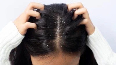 Ini Manfaat Air Kelapa untuk Rambut Rontok, Perlu Diketahui!