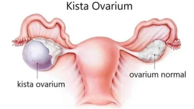 Kista Ovarium. (Sumber Gambar: Alga Rosella)