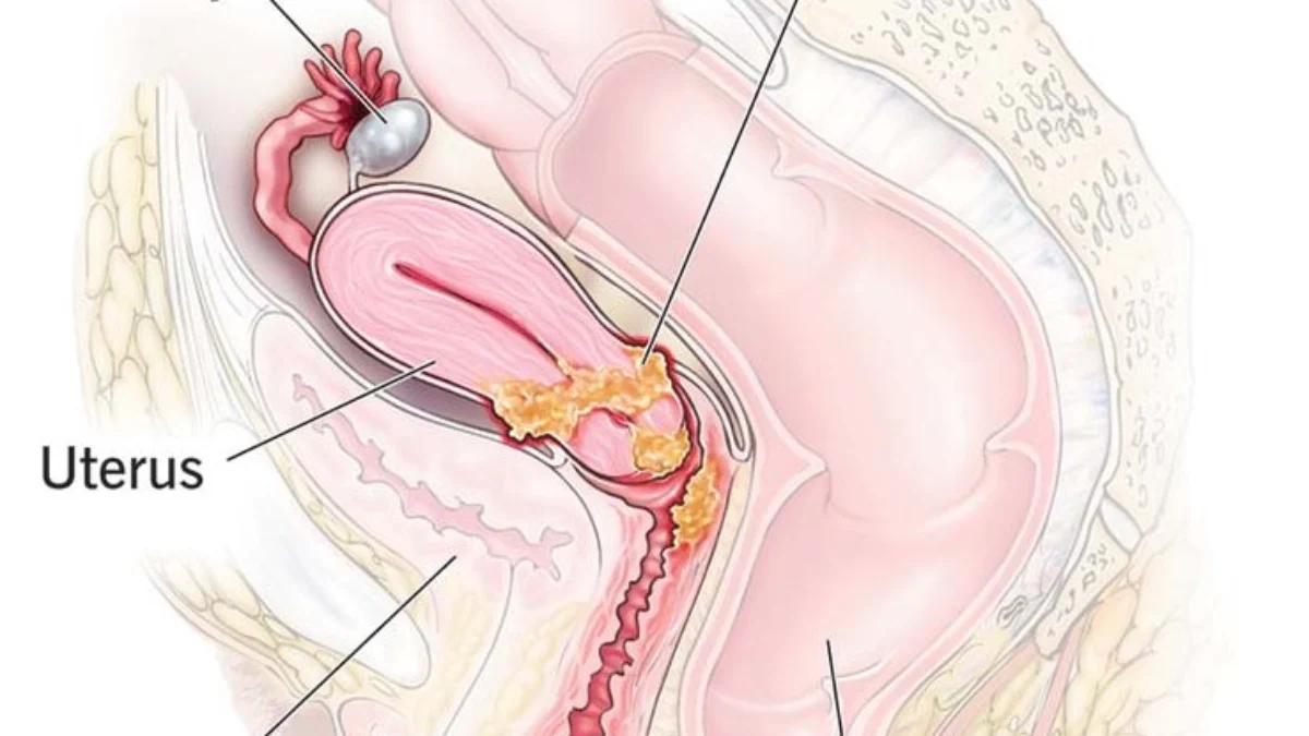 5 Ciri-ciri Kanker Sarkoma Rahim. (Sumber Gambar: Cleveland Clinic)