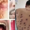 Waspada Mpox! Pemeriksaan Kesehatan Ketat bagi WNA di Perbatasan Indonesia