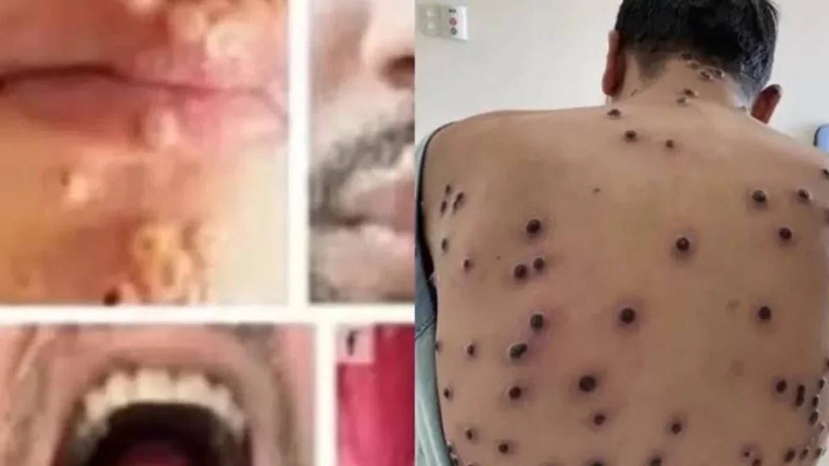 Waspada Mpox! Pemeriksaan Kesehatan Ketat bagi WNA di Perbatasan Indonesia