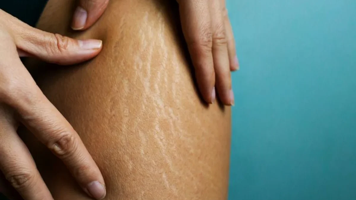 Penyebab Stretch Mark pada Remaja, Faktor Utama dan Cara Mengatasinya dengan Efektif