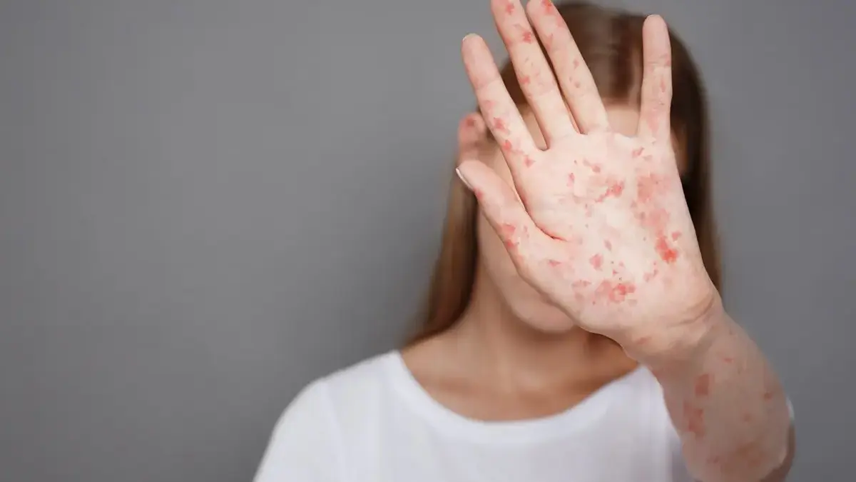 Ilustrasi campak (Lifepack,id)