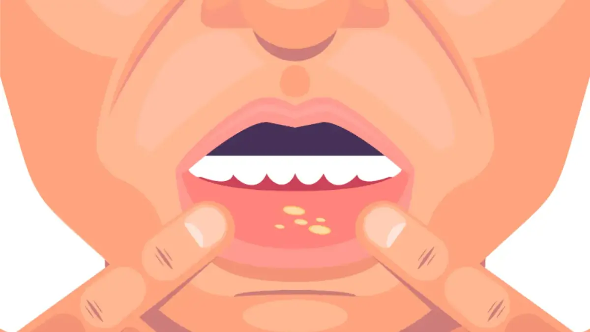 Cara Mengobati Sariawan di Bibir, Efektif Sembuh dengan Cepat