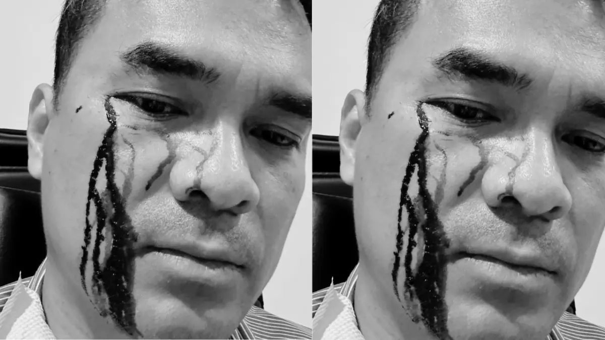 Penampakan Wajah Bro Ron Usai Dipukuli 2 Preman, Darah Mengucur di Pelipis Mata.